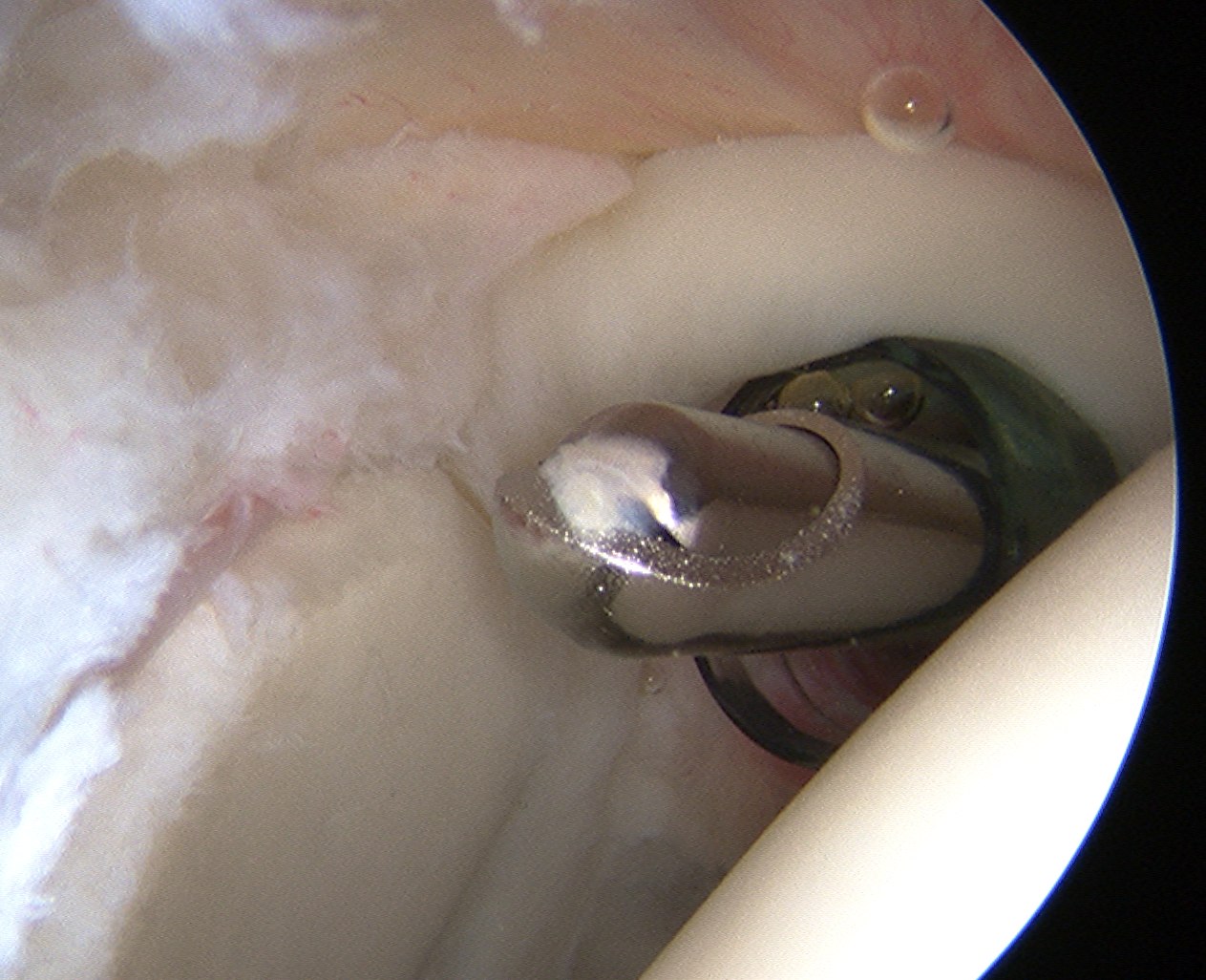 Shoulder Arthroscopy Anterosuperior Portal